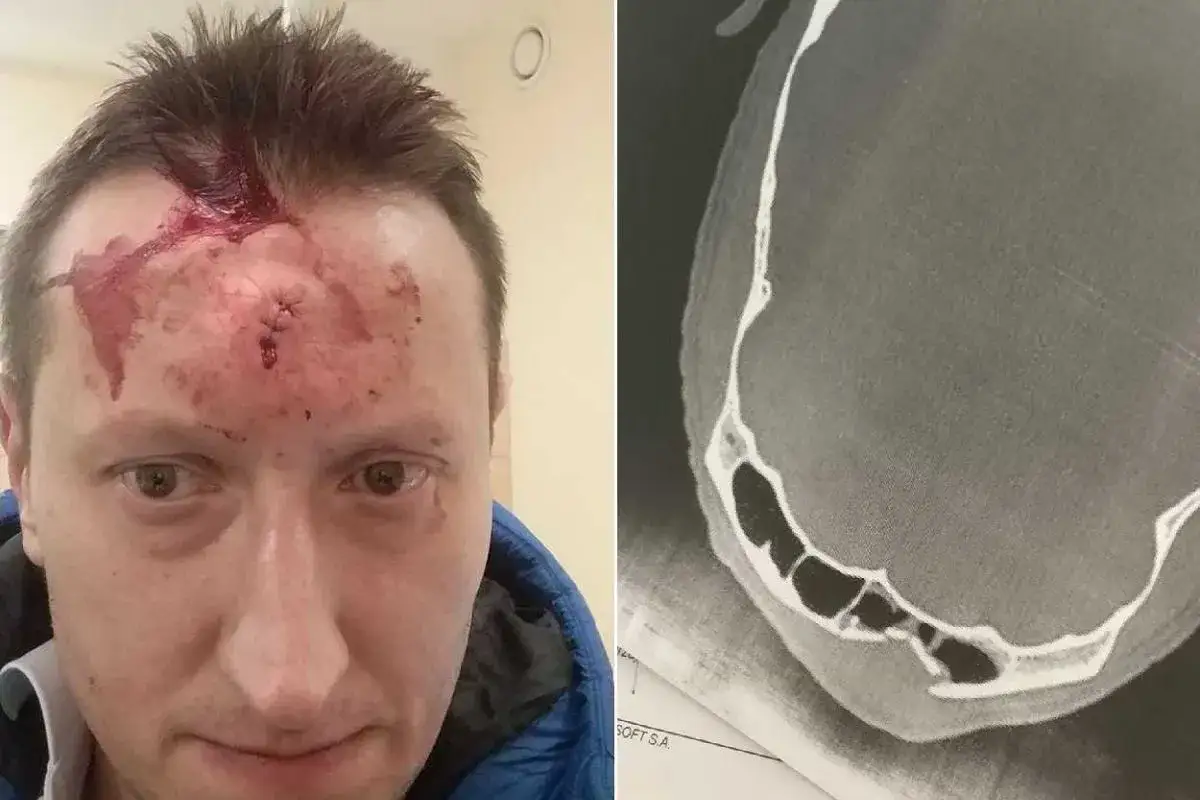 obrażenia po uderzeniu kastetem