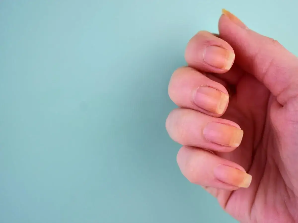 Zdjęcie Skuteczne domowe sposoby na żółte paznokcie, które naprawdę działają