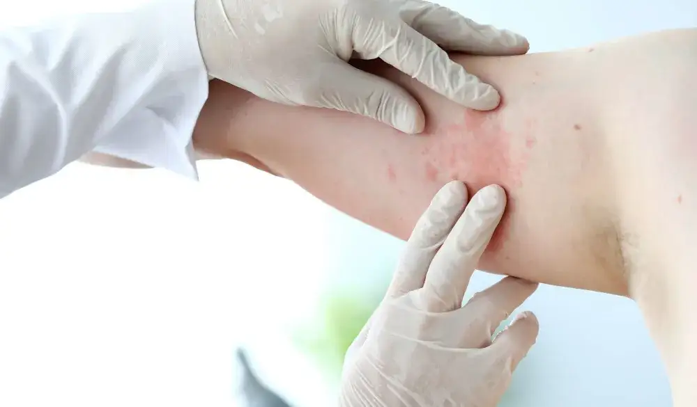 Zdjęcie Alergia na nabiał objawy skórne: jak je rozpoznać i leczyć