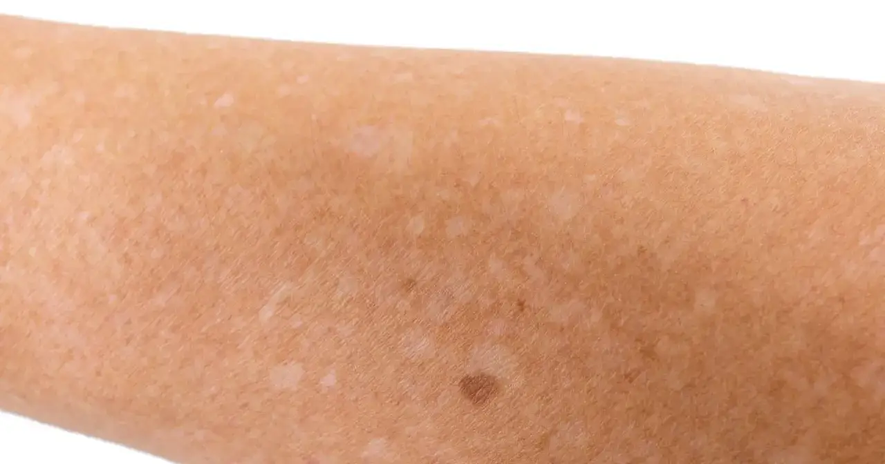 Jasnobrązowa skóra z widocznymi, jaśniejszymi przebarwieniami. Białe kropki na skórze tworzą mozaikę na ręce.