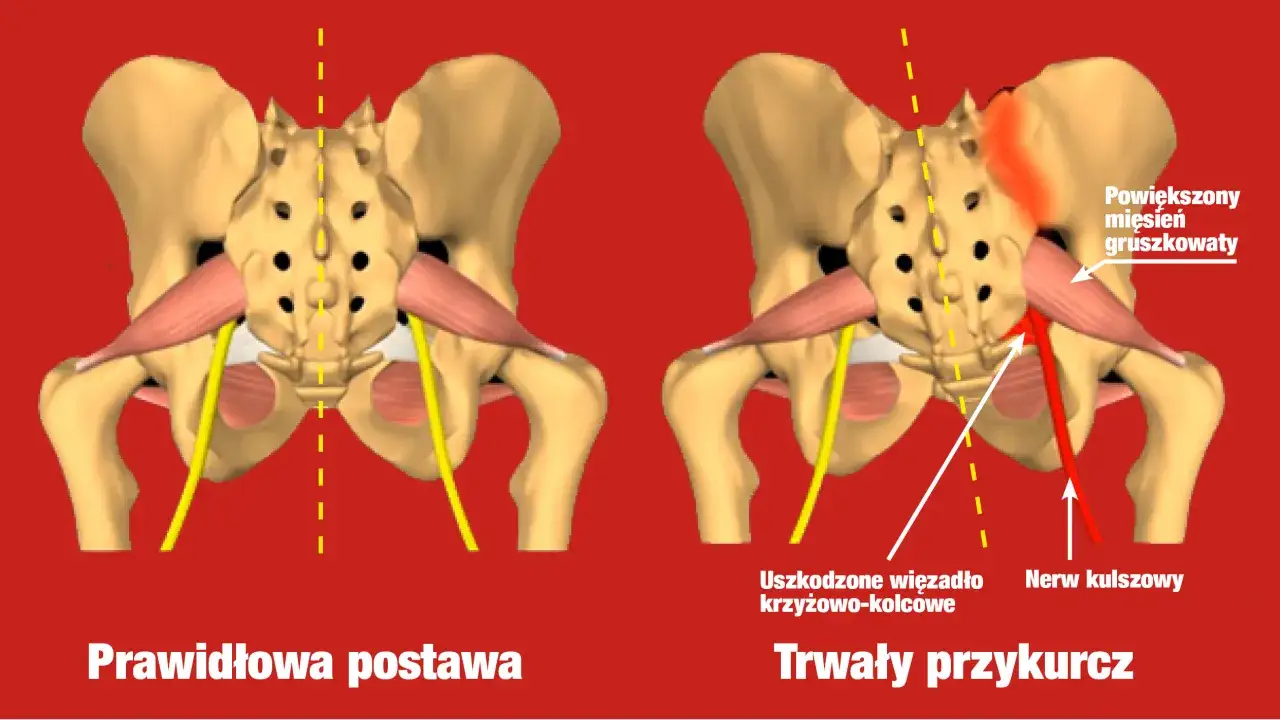 Prawidłowa postawa vs. trwały przykurcz z powiększonym mięśniem gruszkowatym, uciskającym nerw kulszowy. Ćwiczenia na mięsień gruszkowaty pomagają.