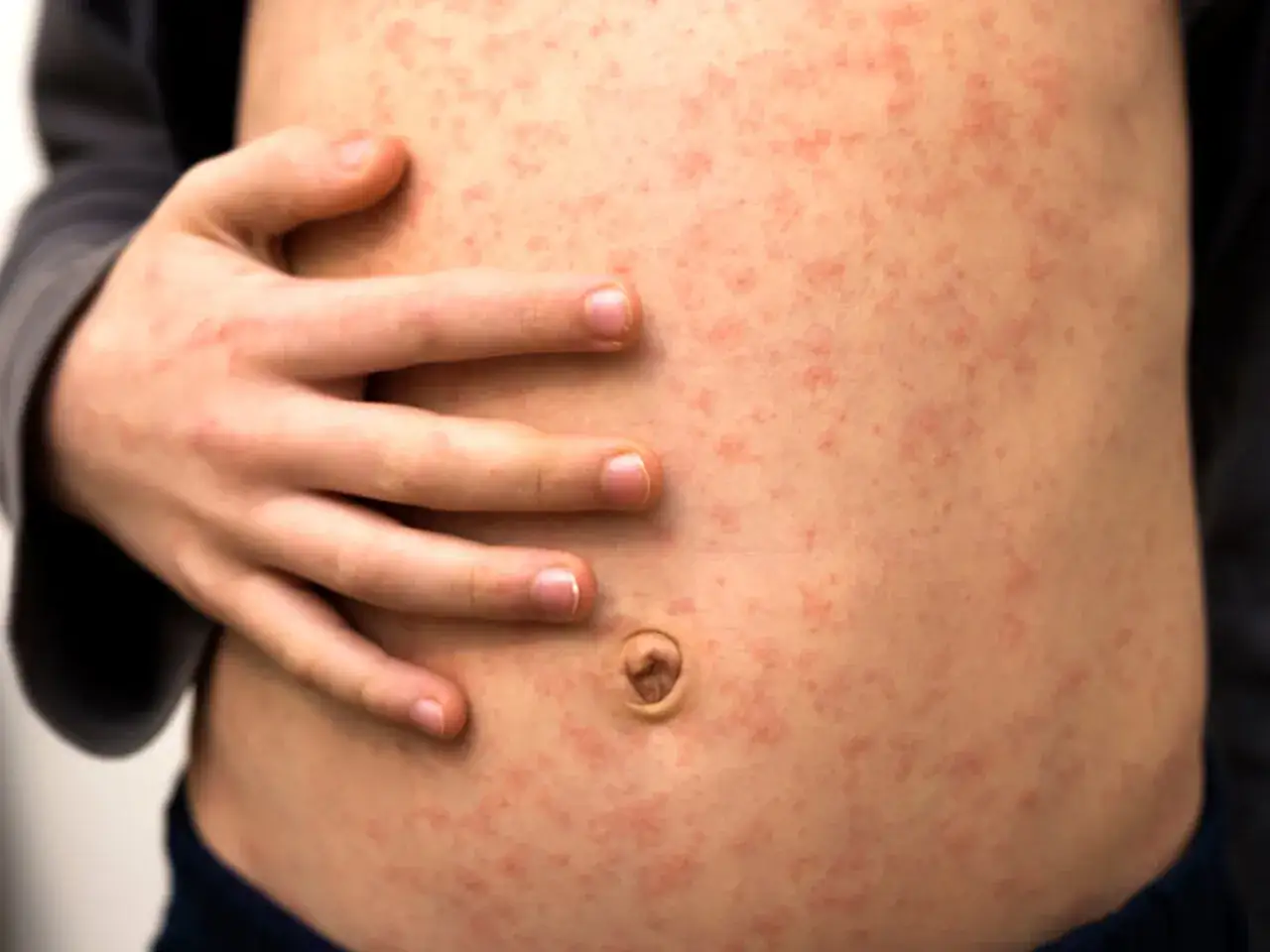 Dziecko z objawami alergii, katar, kaszel, wysypka