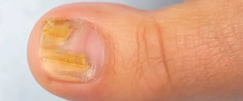 Zdjęcie O czym świadczą żółte paznokcie i jak uniknąć poważnych problemów zdrowotnych