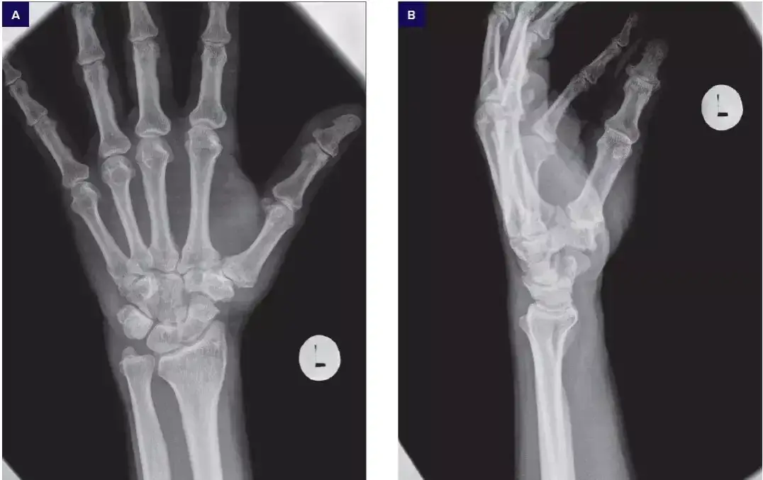 Zdjęcie rentgenowskie dłoni ze zmianami zwyrodnieniowymi