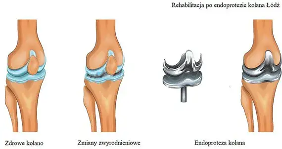 harmonogram rehabilitacji po endoprotezie kolana