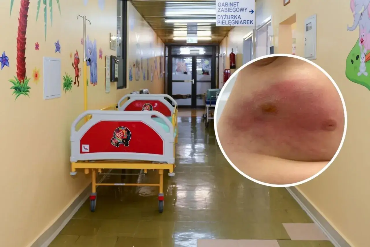 Dziecko z powikłaniami po RSV, widoczne zaczerwienienie i obrzęk na brzuchu. W tle szpitalny korytarz z łóżkami.