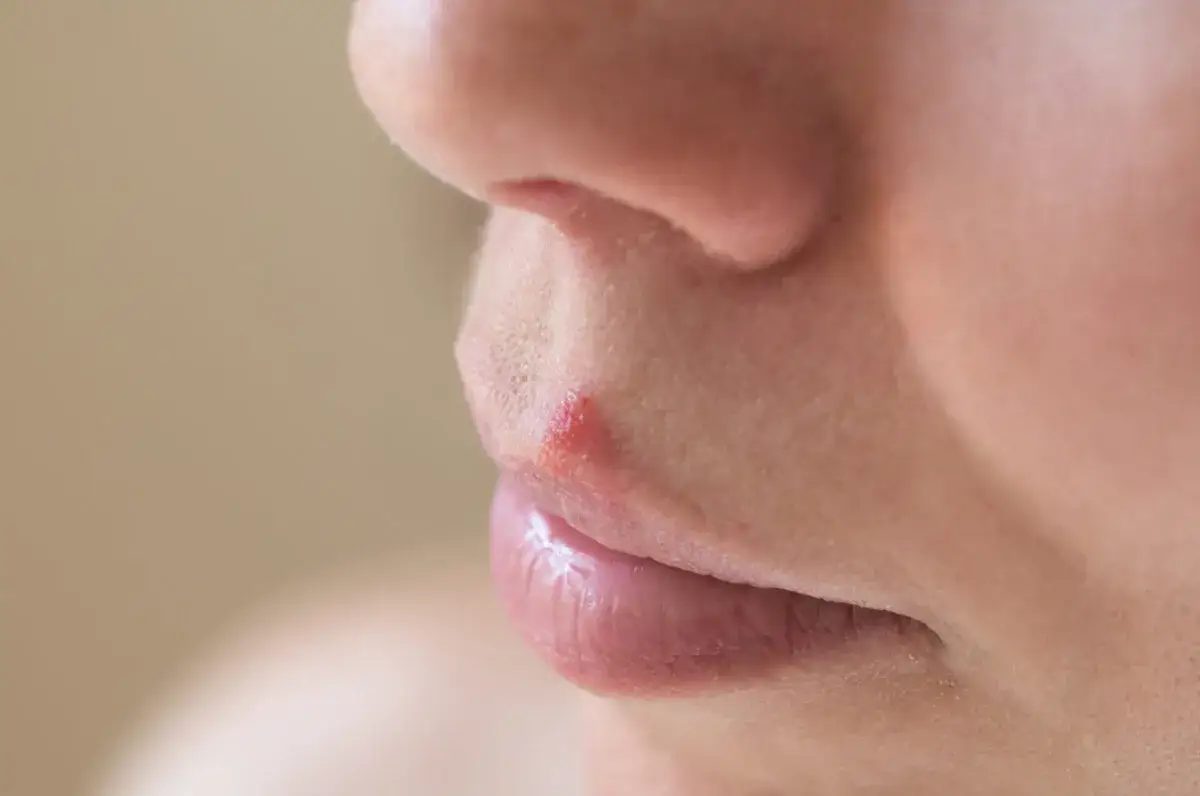 opryszczka wargowa ryzyko u dentysty