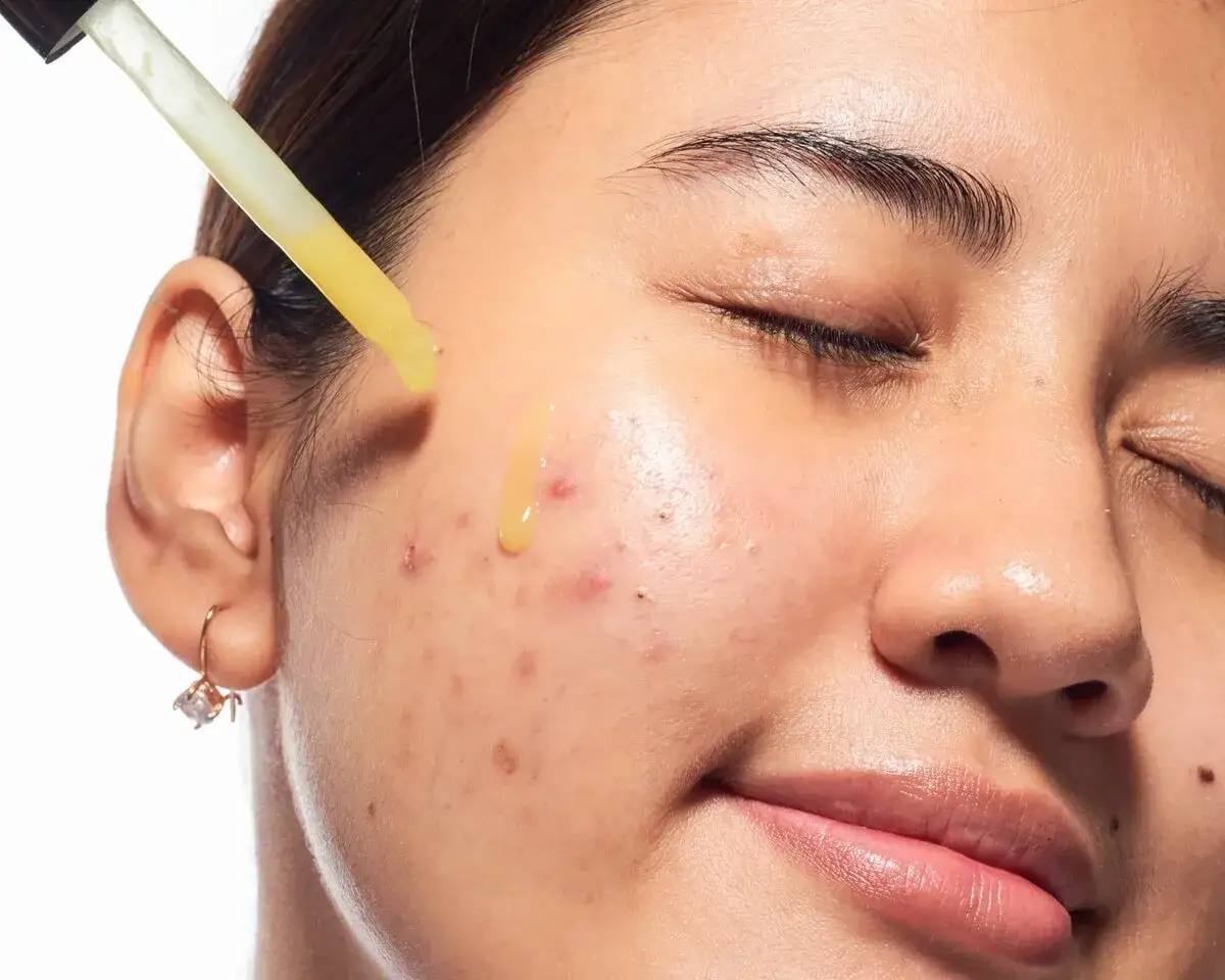 składniki aktywne na trądzik i ich działanie