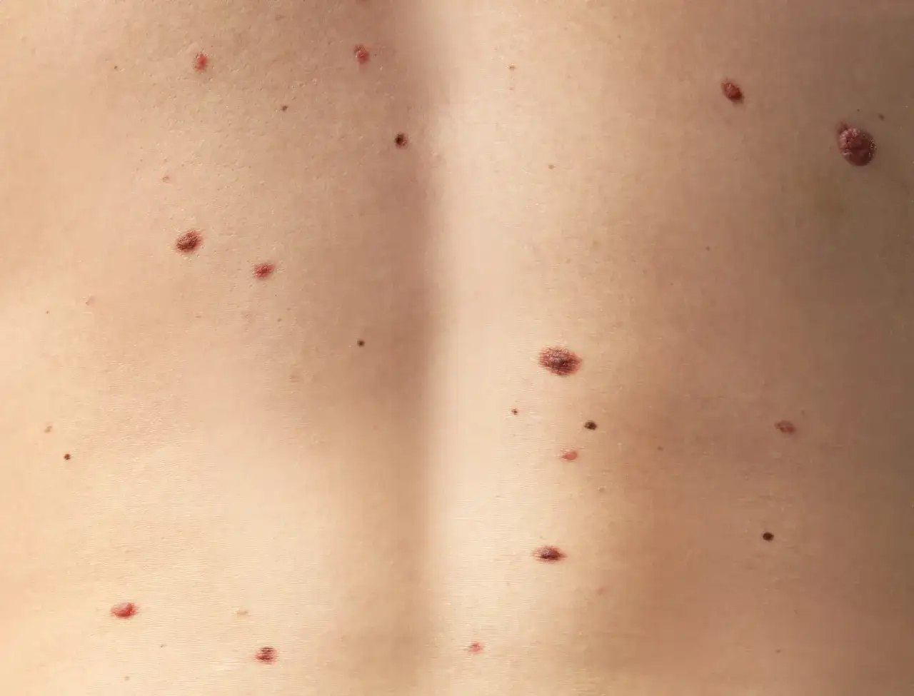 Skóra z licznymi pieprzykami. Czy na pieprzyku może zrobić się pryszcz? To pytanie nurtuje wiele osób, gdy zauważą zmianę na swojej skórze.