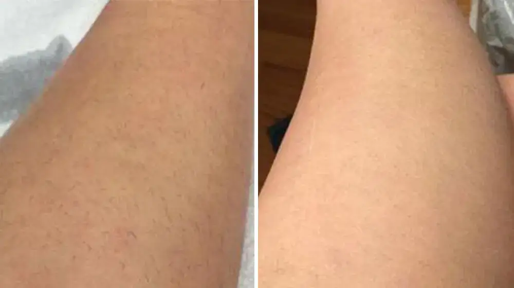 kobieta podczas zabiegu depilacji laserowej na nogach