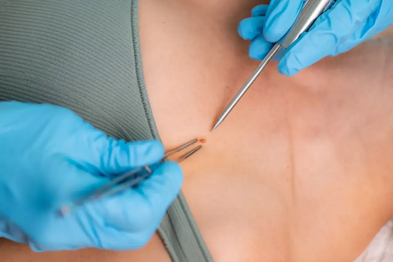 Lekarz w niebieskich rękawiczkach wykonuje biopsję sk&oacute;ry, używając precyzyjnych narzędzi do pobrania pr&oacute;bki znamienia.