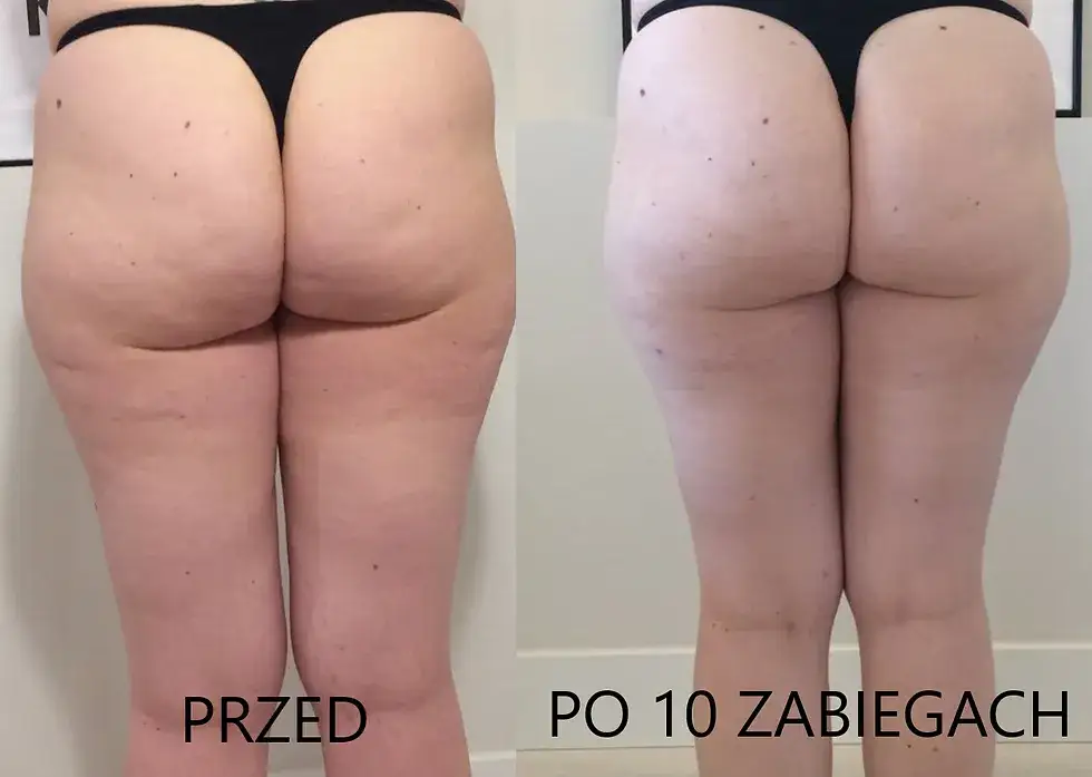 Masaż bańką chińską przed i po efekty