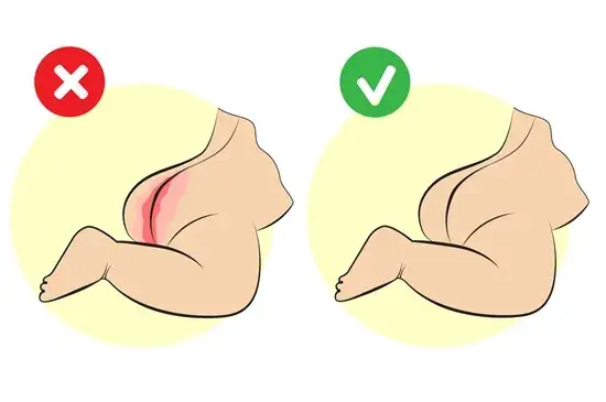 zdrowa pupa niemowlaka vs odparzenia pieluszkowe
