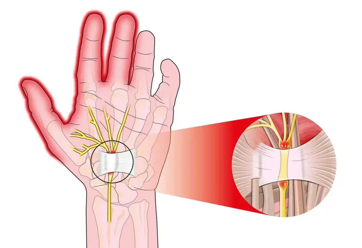 Ilustracja pokazuje ucisk na nerw pośrodkowy w nadgarstku, objaw zespołu cieśni nadgarstka. Neurolog czy ortopeda pomoże zdiagnozować problem.