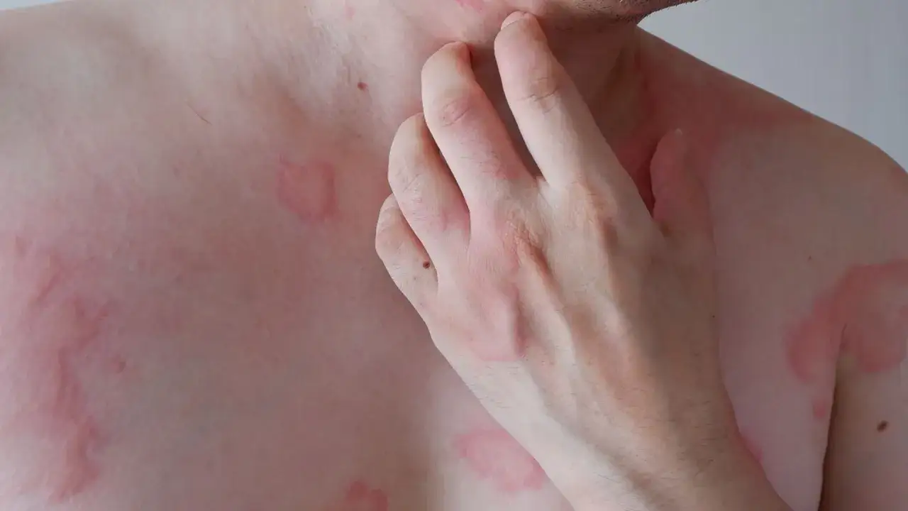 Czerwone, swędzące plamy na sk&oacute;rze, kt&oacute;re mogą być objawem nietolerancji histaminy. Dłoń drapie podrażnione miejsca.