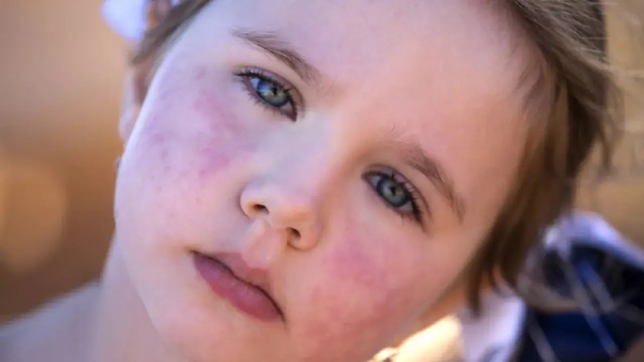 Czerwone policzki dziecka, jakby od wewnątrz bolały, z widocznymi zaczerwienieniami i drobnymi krostkami.