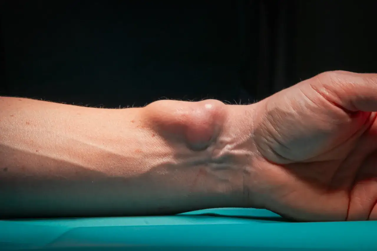 Widoczny twardy guzek na wewnętrznej stronie dłoni, tuż przy nadgarstku, uwypuklający się na skórze.