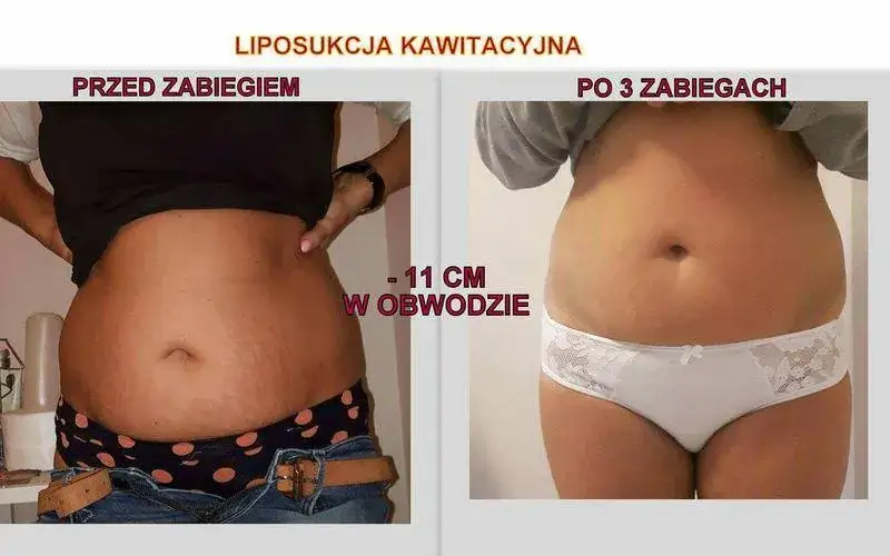 kriolipoliza i liposukcja kawitacyjna por&oacute;wnanie