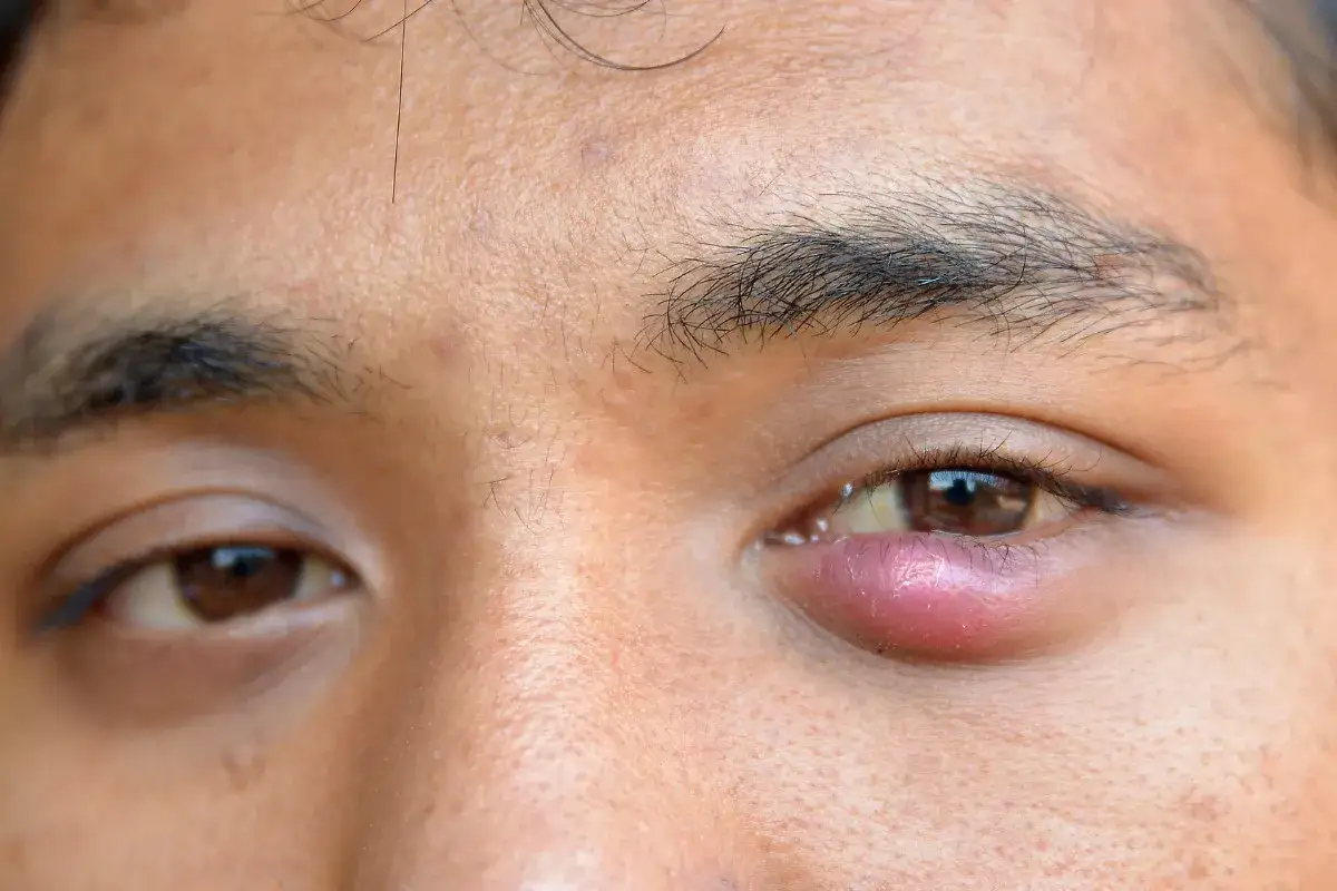 Higiena oczu profilaktyka jęczmienia