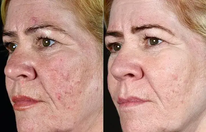 przed i po zabiegu laser frakcyjny blizny potrądzikowe