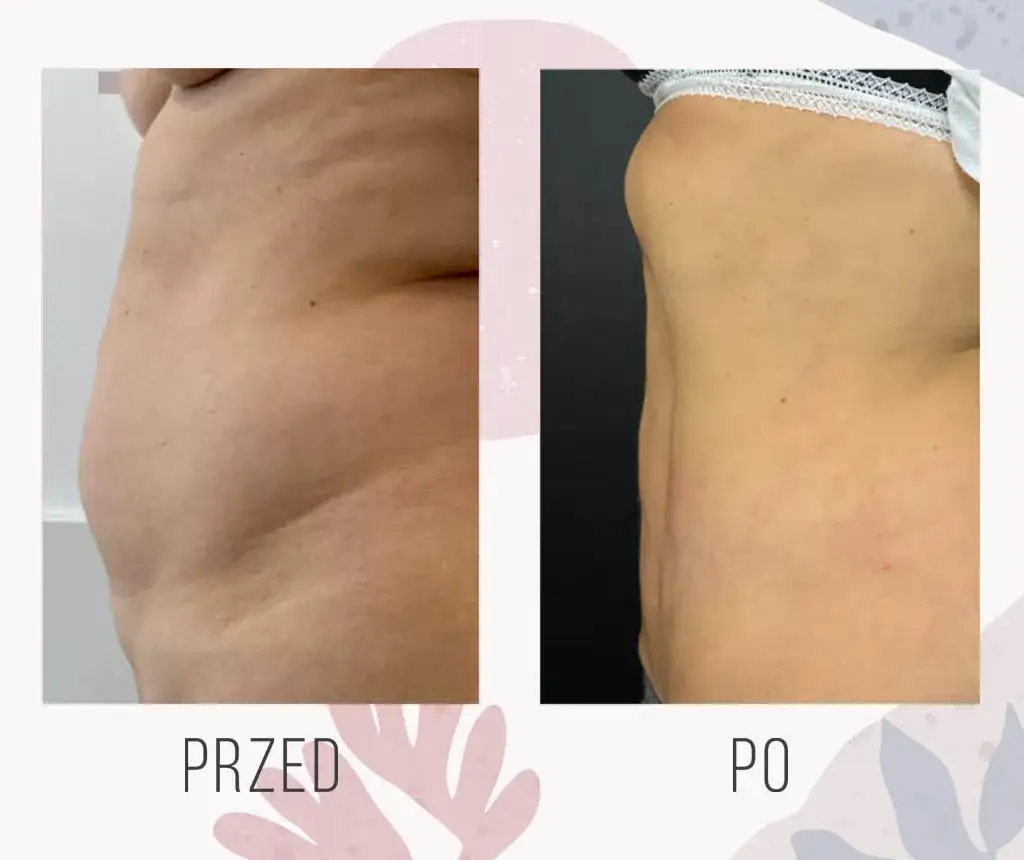 Zdjęcie Liposukcja gdzie najlepiej: wybierz najlepsze kliniki w Polsce