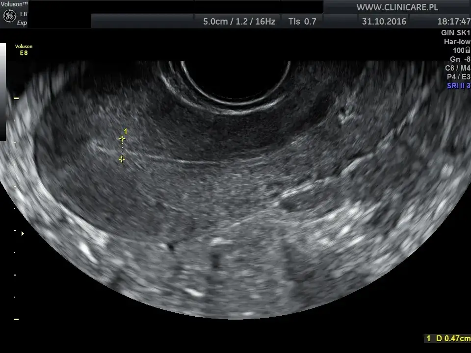 USG ginekologiczne dopochwowe obraz