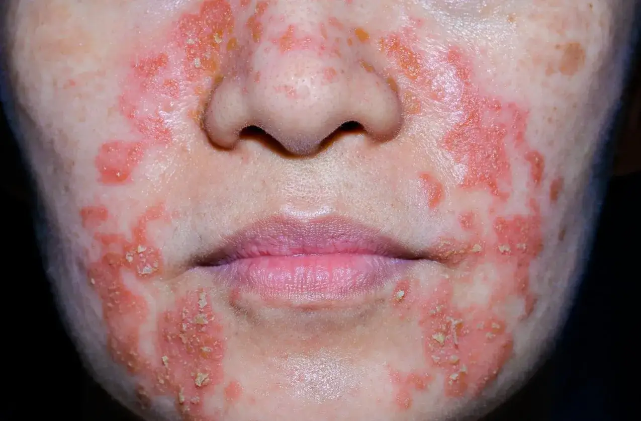 Widoczne stany zapalne na twarzy, zaczerwienione plamy z łuszczącą się sk&oacute;rą wok&oacute;ł ust i nosa.