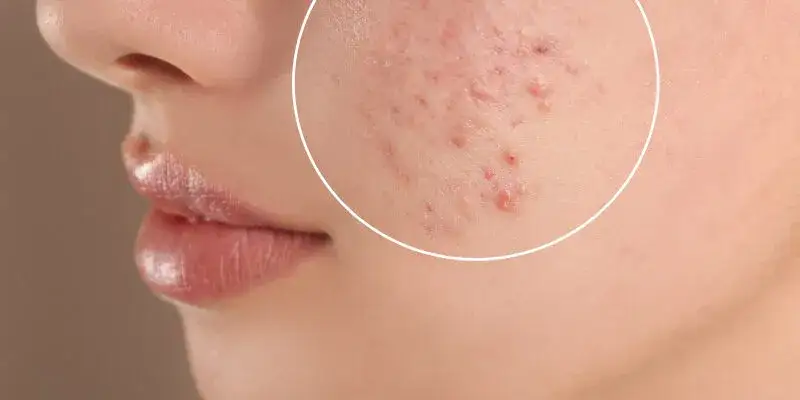 Profesjonalne zabiegi na blizny potrądzikowe