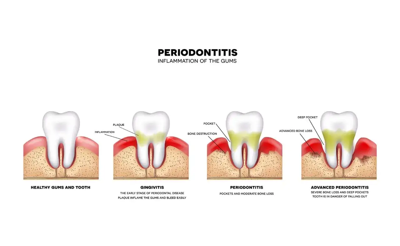 Ilustracja pokazuje postępujące zapalenie dziąseł objawy: od zdrowych dziąseł, przez zapalenie, po zaawansowaną paradontozę z utratą kości.