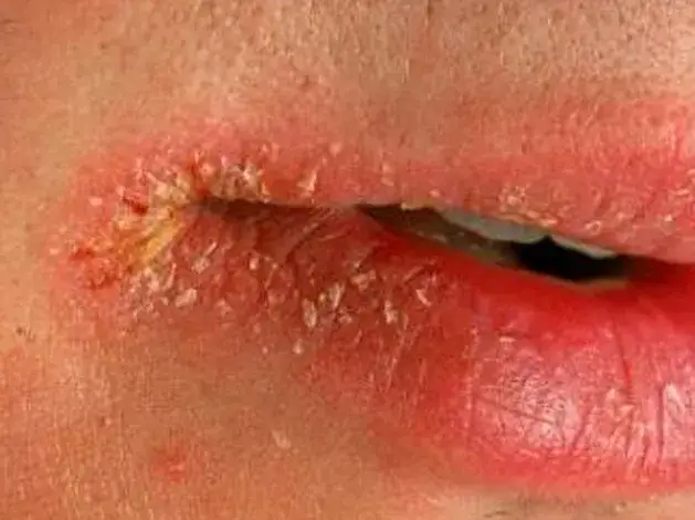 objawy niedoboru witaminy b skóra zajady