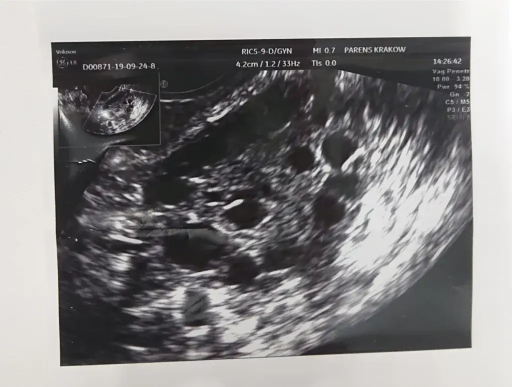 badania hormonalne u kobiet PCOS niepłodność