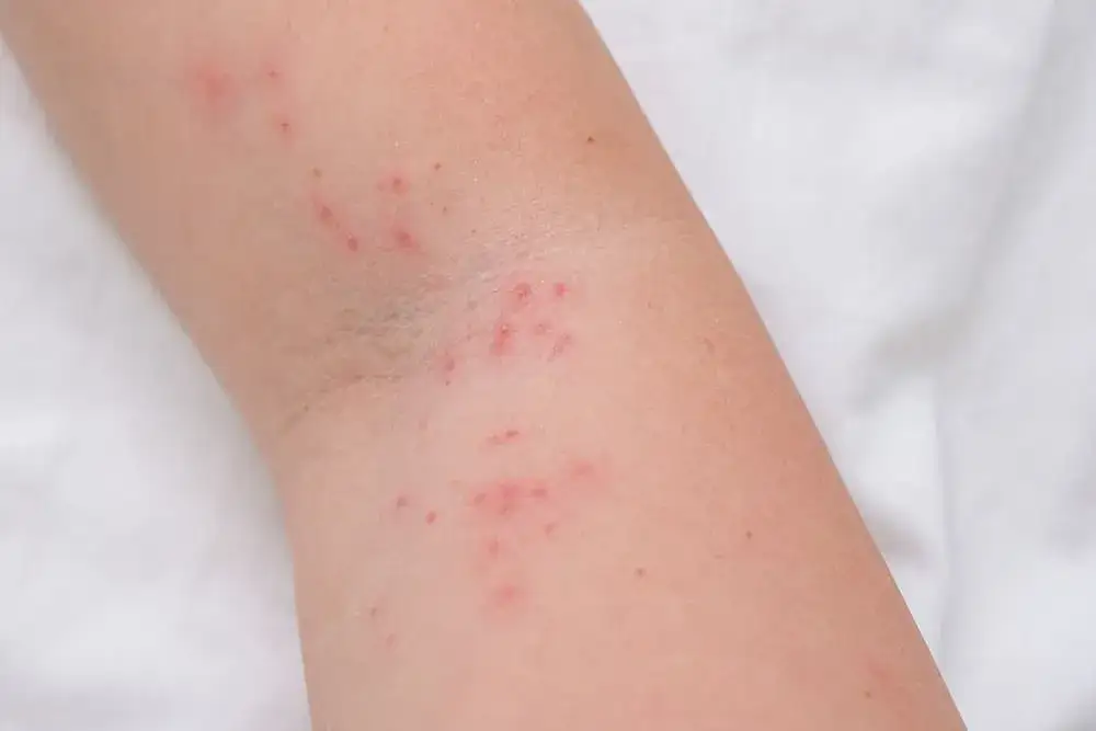 Alergia skórna u dziecka zmiany na policzkach zgięciach łokci