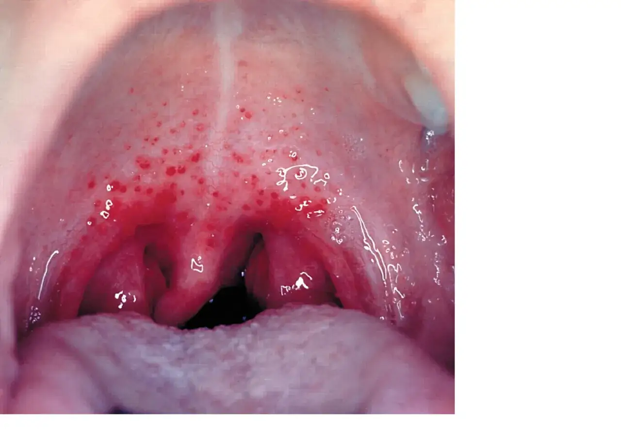 Jama gardła z czerwonymi plamkami i obrzękniętymi migdałkami, objawy mogą sugerować szkarlatynę, która wymaga szczepienia.