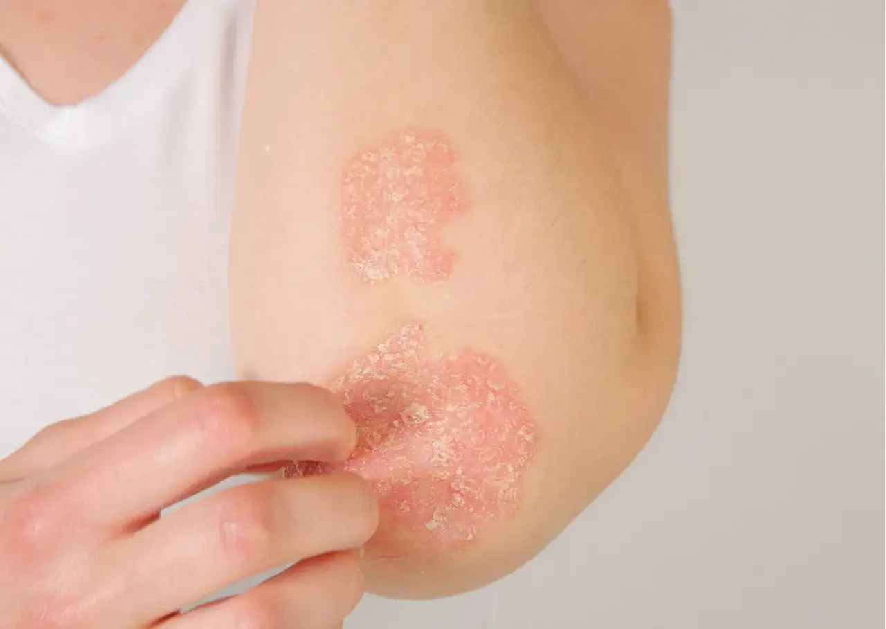 Łuszczyca pierwsze objawy na łokciu: czerwone, łuszczące się plamy. Dłoń delikatnie dotyka swędzącej skóry.