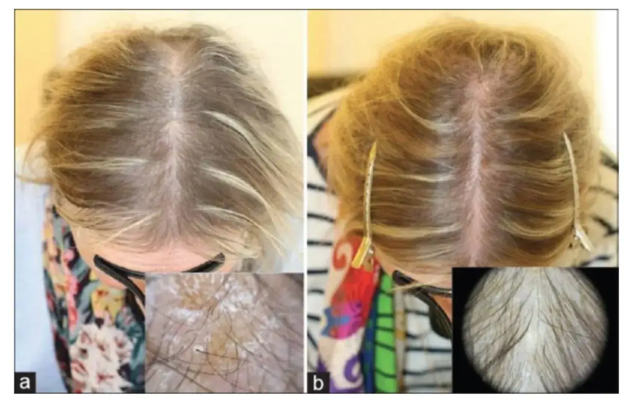 Przed i po zastosowaniu biotyny na włosy. Widoczna poprawa gęstości i jakości włosów.