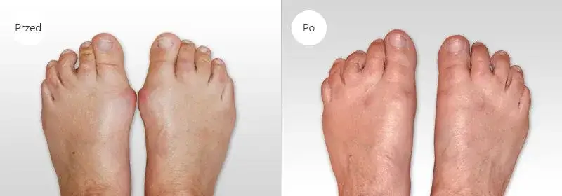 stopa z haluksem i stopa po operacji porównanie