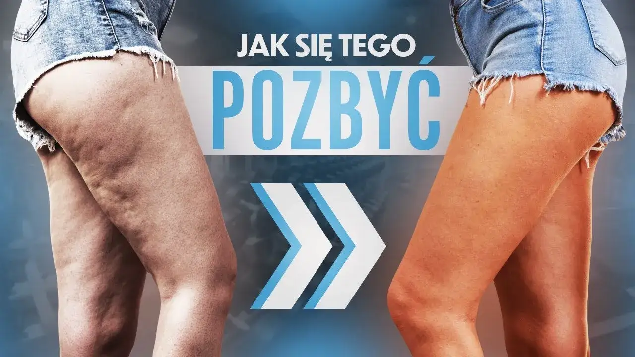Zdjęcie Bezpieczne zabiegi na cellulit przy żylakach, które naprawdę działają