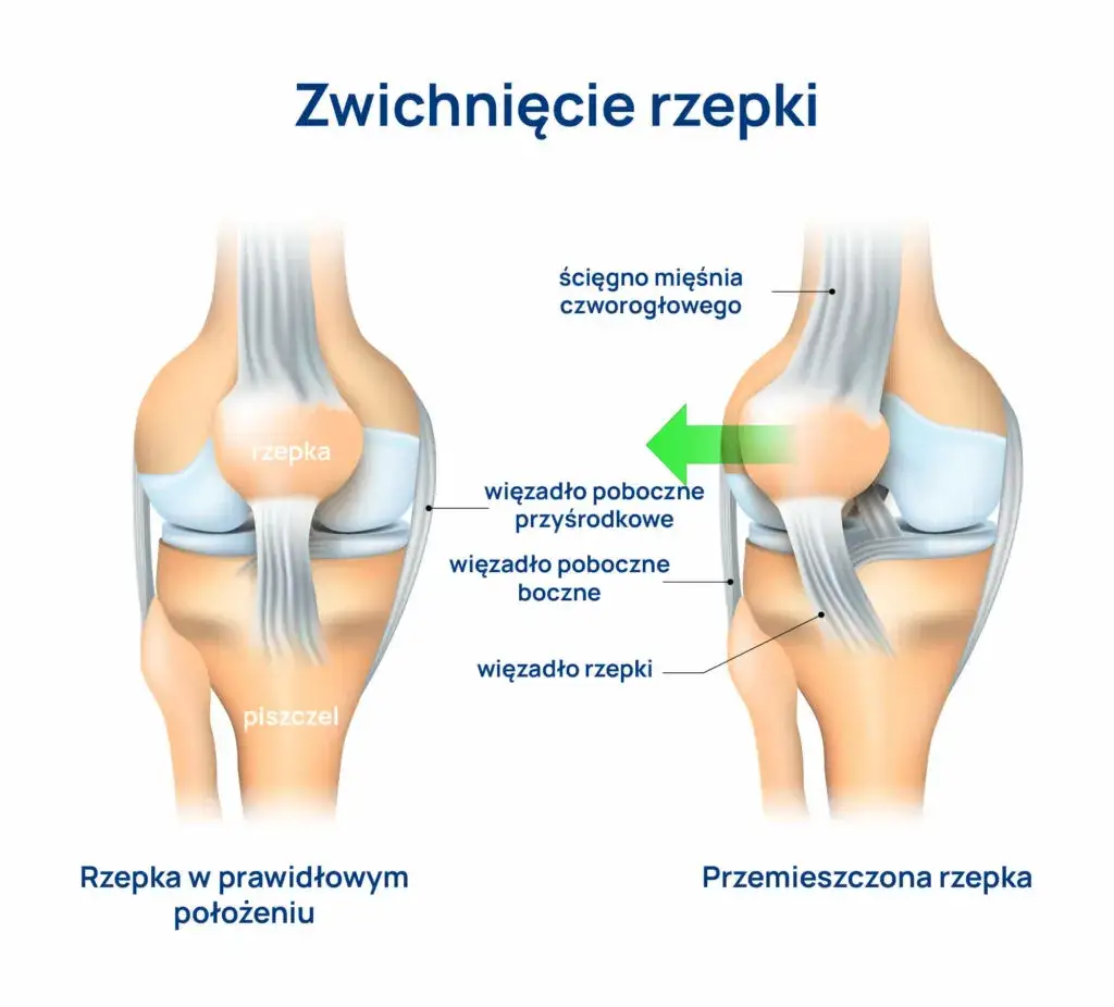 objawy skręcenia kolana infografika