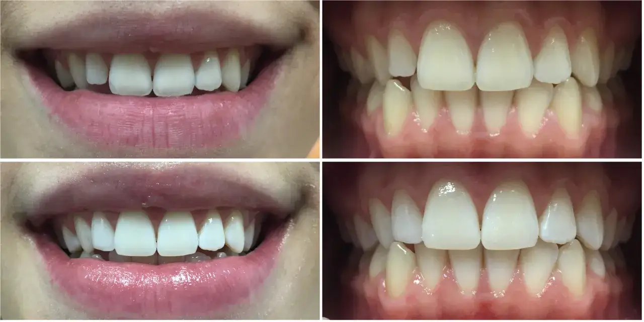 Zabiegi stomatologiczne odbudowa zębów