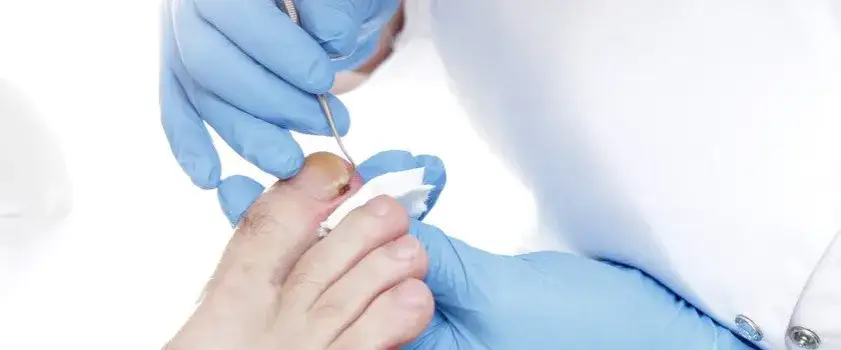 Zdjęcie Co zrobić, jak paznokieć wrasta w palec? Skuteczne metody leczenia