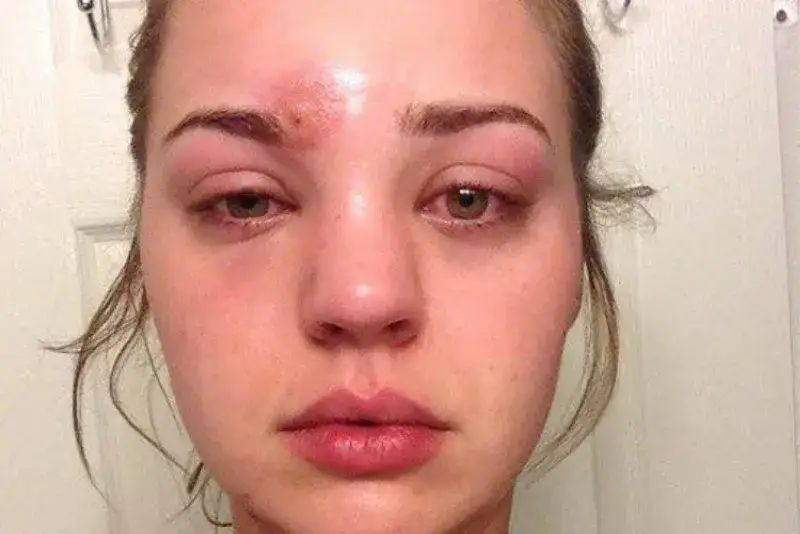 skóra z zaczerwienieniem po wyciśnięciu pryszcza