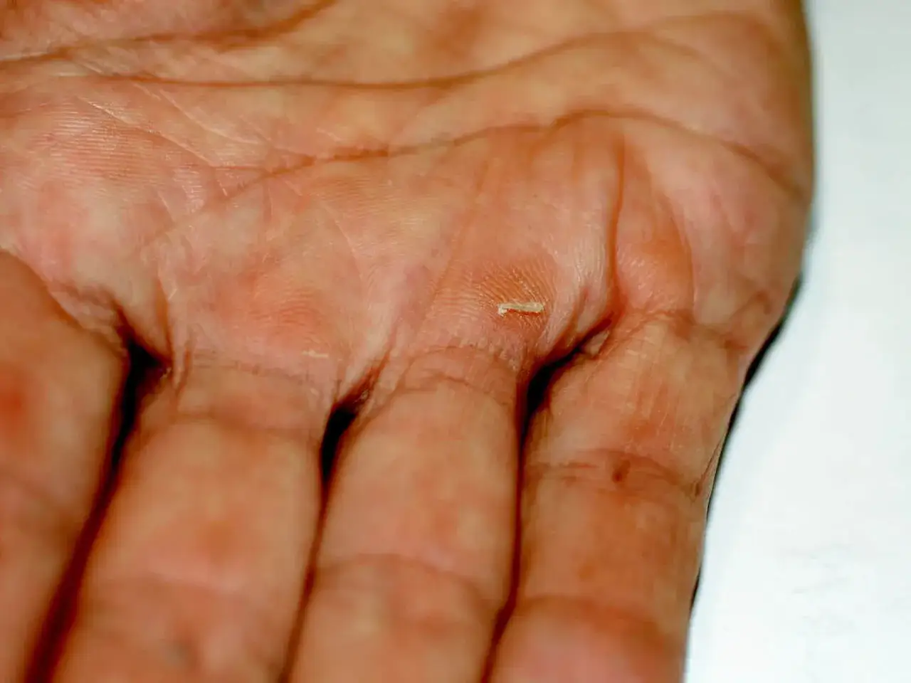 Drobny odprysk drewna tkwi w skórze dłoni, widoczne linie papilarne i zgrubienia.