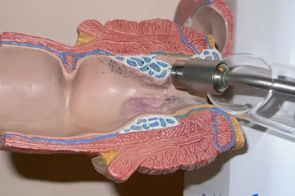 leczenie hemoroidów metody małoinwazyjne