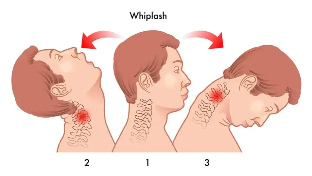 mechanizm urazu smagnięcia biczem whiplash