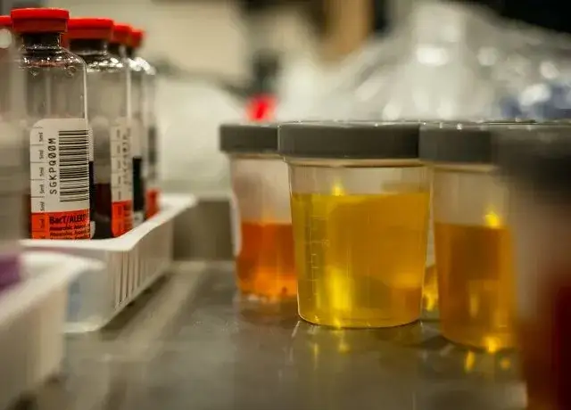 Zdjęcie Krew w moczu jakie badania? Sprawdź, co może to oznaczać