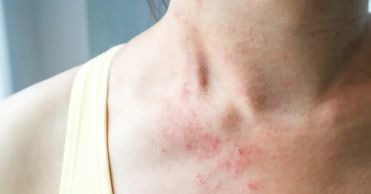 Sk&oacute;ra na szyi i dekolcie z zaczerwienieniem i wysypką. Nadmanganian potasu na co? Na podrażnienia i stany zapalne sk&oacute;ry.