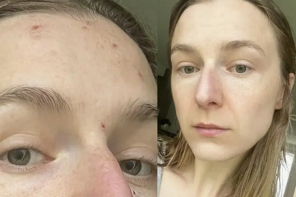 korektor na niedoskonałości przed i po