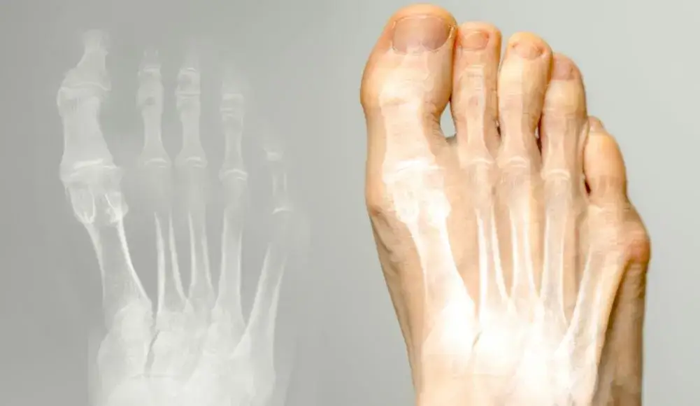 haluks małego palca anatomia stopy