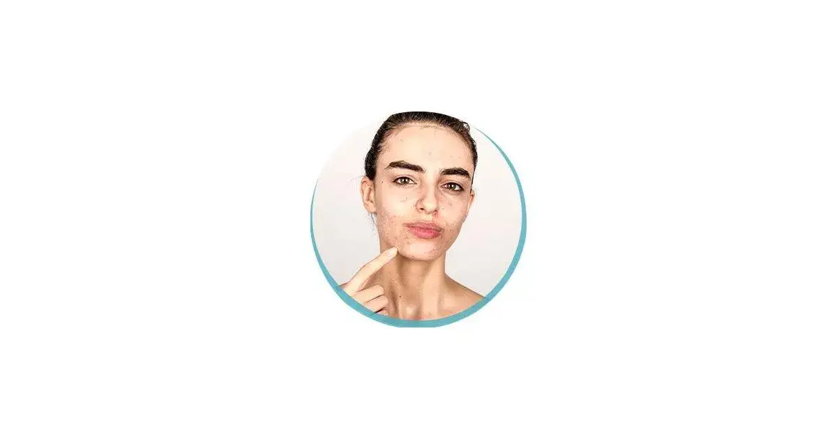 Zdjęcie Pryszcze objawy ciąży: co musisz wiedzieć o trądziku w ciąży