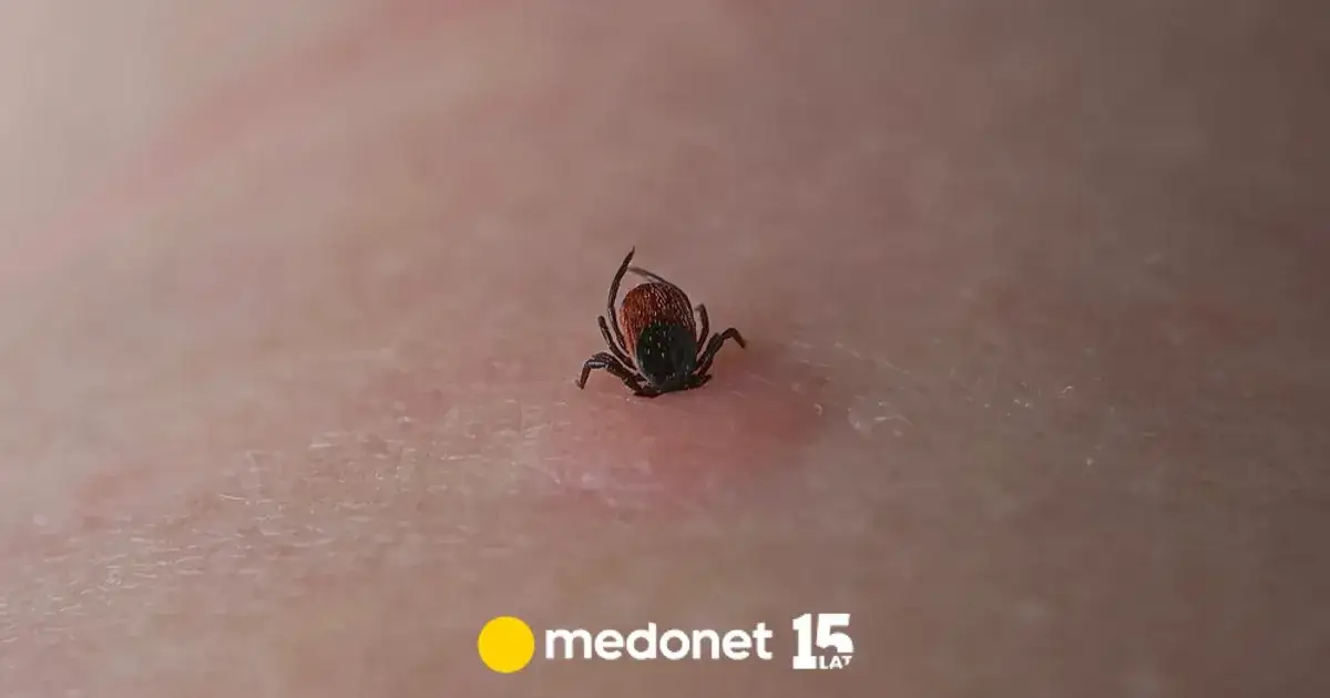 Zdjęcie Kleszcz pod skórą objawy - jak rozpoznać niebezpieczeństwo boreliozy
